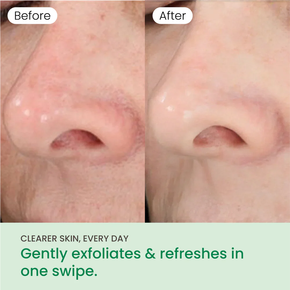 No More Pore Pads - Image 4